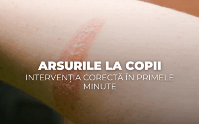 Arsurile la copii – intervenția corectă în primele minute