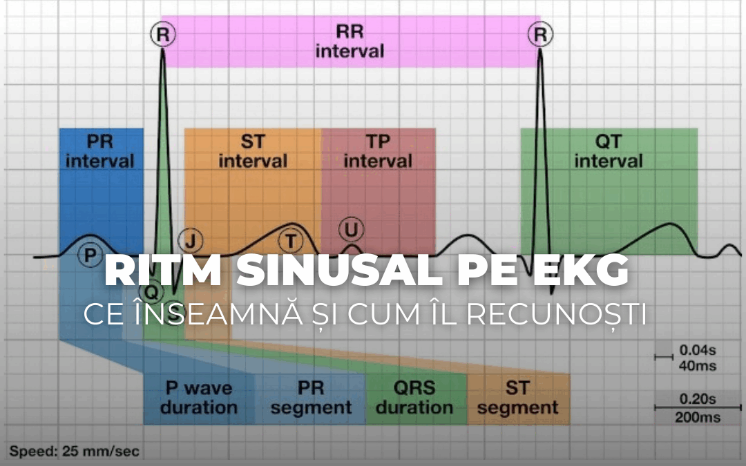 Ritm sinusal pe EKG – ce înseamnă și cum îl recunoști