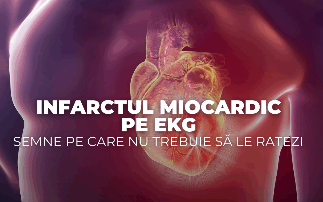 Infarctul miocardic pe EKG – semne pe care nu trebuie să le ratezi