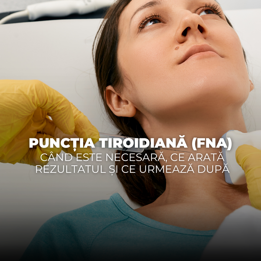 ARTICOLE BLOG-93 Puncția tiroidiană (FNA)